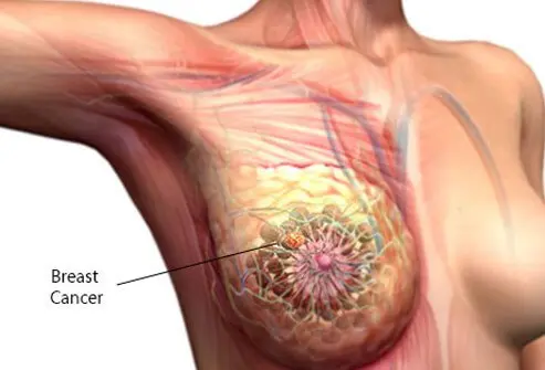 Medical image highlighting surgical anatomy of breast and lymph nodes relevant to Breast Cancer Treatment In Indore