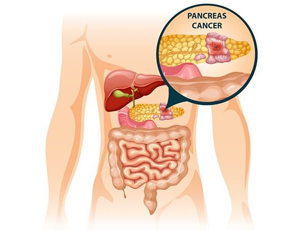 Medical illustration of human abdomen anatomy showing highlighted pancreas with cancerous lesion for oncology education by Dr. Hozefa Lokhandwala best oncology specialist in Indore