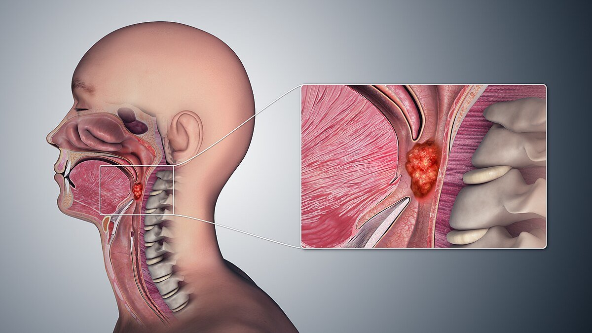 Medical illustration of head and neck anatomy showing oral cavity and pharyngeal cancer tumor for head neck oncology education by Dr. Hozefa Lokhandwala best oncology specialist in Indore