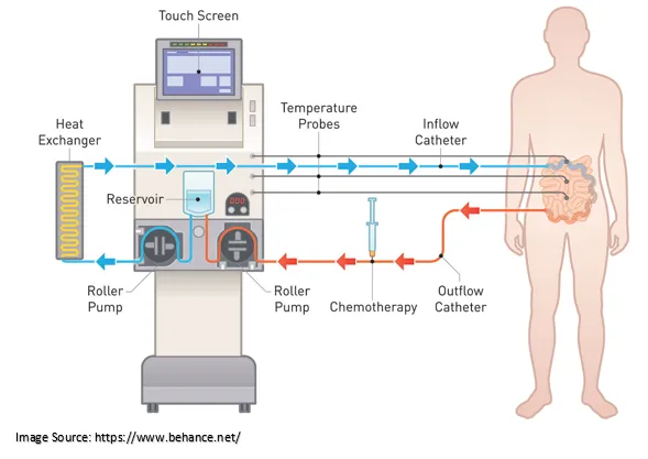 HIPEC chemotherapy system diagram showing heated chemotherapy circulation for abdominal cancer treatment highlighting innovative care by Dr. Hozefa Lokhandwala best oncology specialist in Indore
