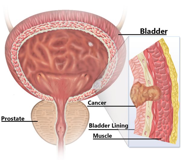 Illustration showing bladder anatomy with labeled cancer muscle lining and prostate highlighting bladder cancer diagnosis and care by Dr. Hozefa Lokhandwala best oncology specialist in Indore