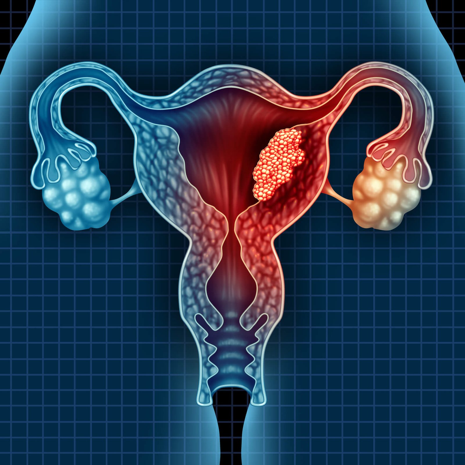 Digital illustration of uterus and ovaries highlighting endometrial cancer in the uterine lining used for oncology awareness by Dr. Hozefa Lokhandwala best oncology specialist in Indore