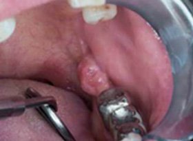 Close-up of lip ulcer as a warning sign needing Oral Cancer Treatment in Indore by Dr. Hozefa Lokhandwala, Best Oncology Specialist in Indore