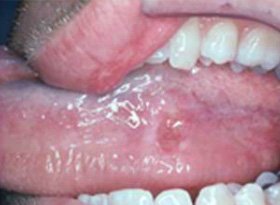 Oral lesion on the side of the tongue, requiring Oral Cancer Treatment in Indore by Dr. Hozefa Lokhandwala, Best Oncology Specialist in Indore