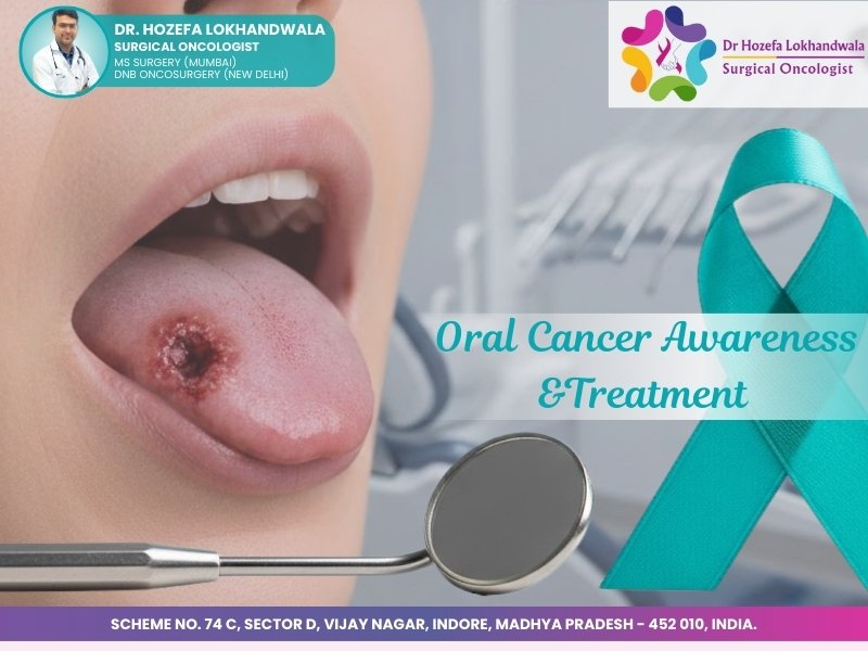 Alt text: Close-up of tongue ulcer suggestive of oral cancer with dental mirror and teal awareness ribbon, promoting oral cancer treatment in Indore by a surgical oncologist in Indore.
